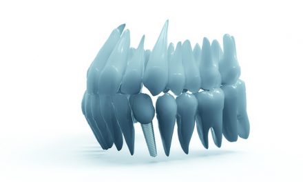 Voor- en nadelen van implantaten