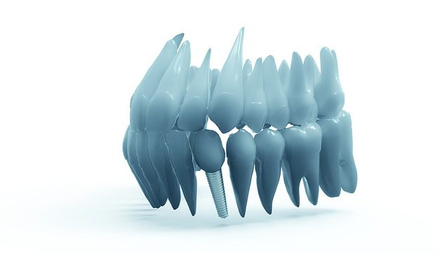 Voor- en nadelen van implantaten